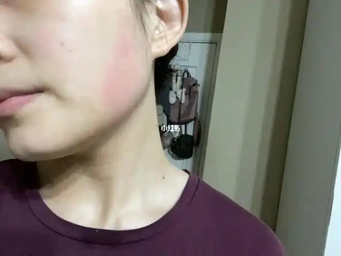 泛红_敏感肌_红血丝修复_过敏_刘亦菲_修复红血丝敏感肌_医疗健康