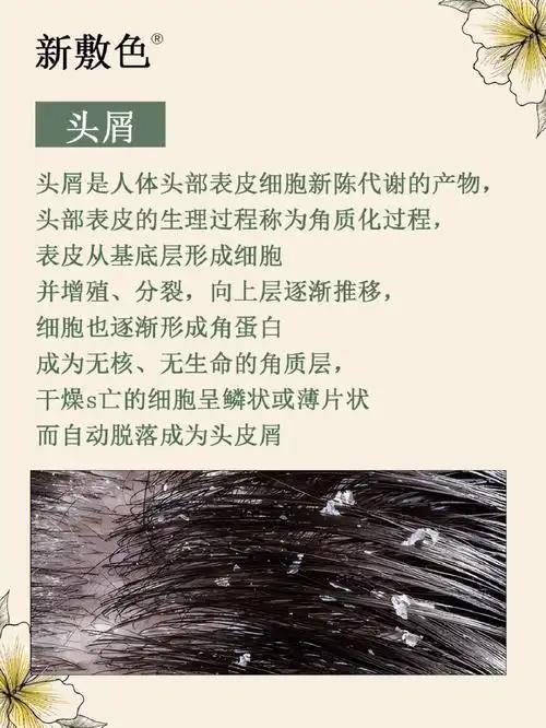 雪花飘飘快来区分头屑和头癣雪花头必看