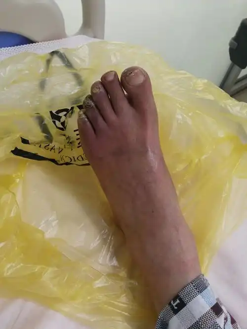 糖尿病足是什么原因(糖尿病足是什么样的)_百科-涨口碑