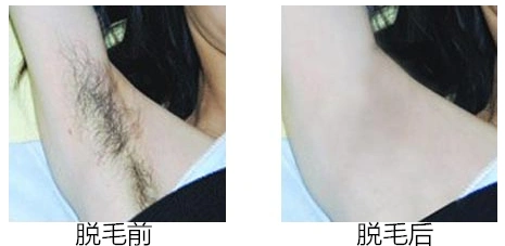 『苏州激光一般需要脱毛脱几次』