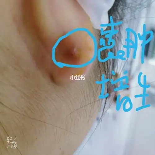 囊肿和增生不是很大的时候,她是19年6份打