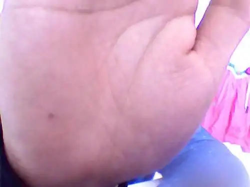 我是一女性,右手掌心偏左有颗红痣,咋办?