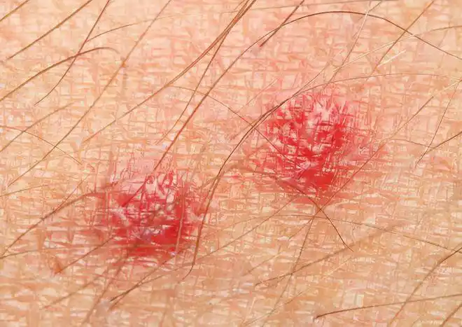 别慌,还可能是这两种情况|毛囊炎|脓疱|外阴_网易订阅