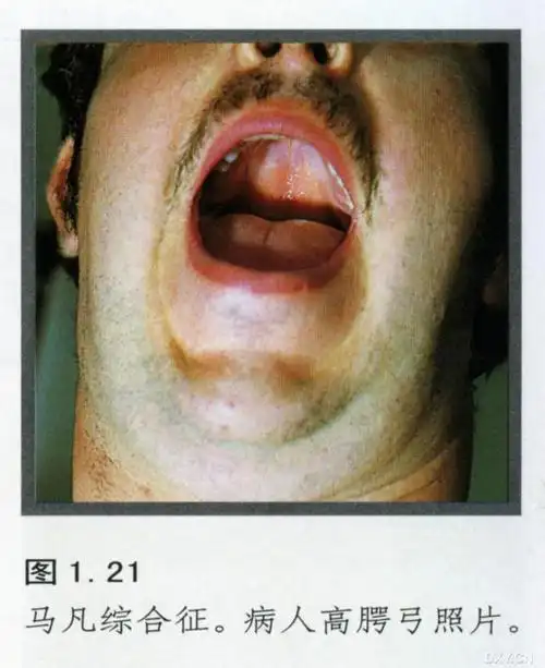 【白内障讨论】马凡氏综合征:悲情的运动天才