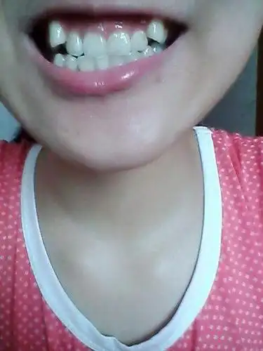 我20岁了,有两颗虎牙,自己觉得比较突出,想要整整,但是朋友,父母都