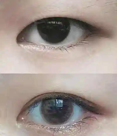 二,埋线双眼皮