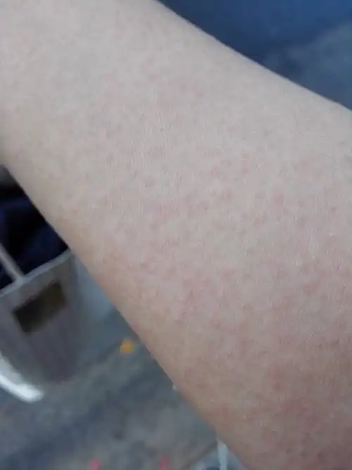 很多小红点,有点痒,帮我看看是什么病吧昨天一下子就起来的,是过敏吗?