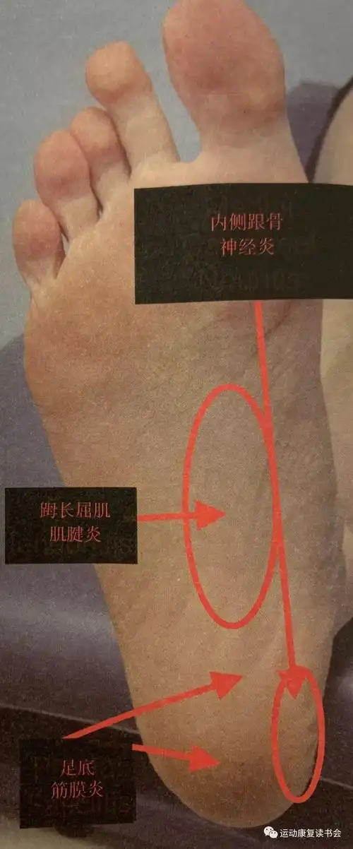 常见足跟痛原因足底筋膜炎的成因及处理方法