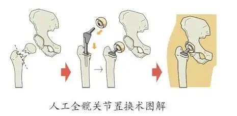 髋关节置换术,有效治疗髋关节疾病