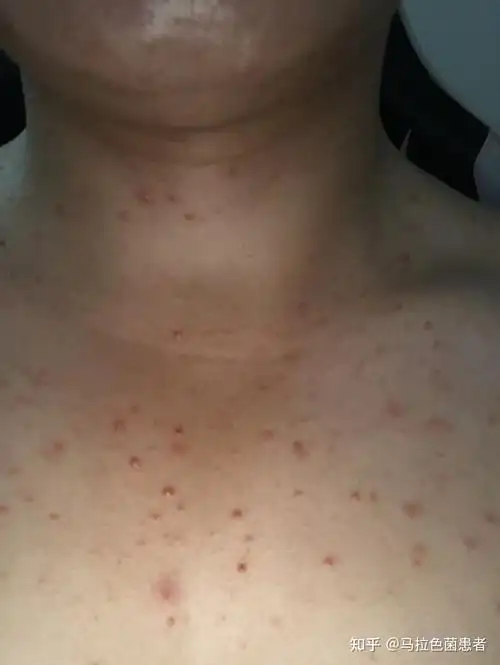 胸前这种毛囊炎不一定是马拉色菌毛囊炎