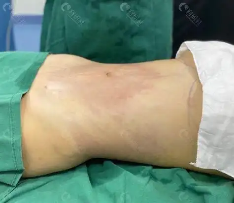 都说吸脂后会凹凸不平,我看这两家中韩医院术后效果就不会