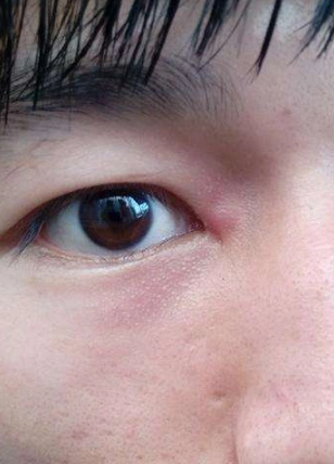 眼睛麦粒肿初期图片7