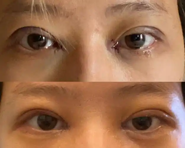 看看我双眼皮提肌是不是失败了福州协和谢义德