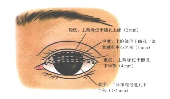 余文林了解上睑下垂抓住最佳矫正时期