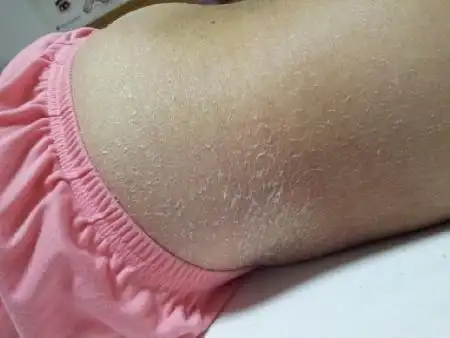 目睹全身爆皮的女人