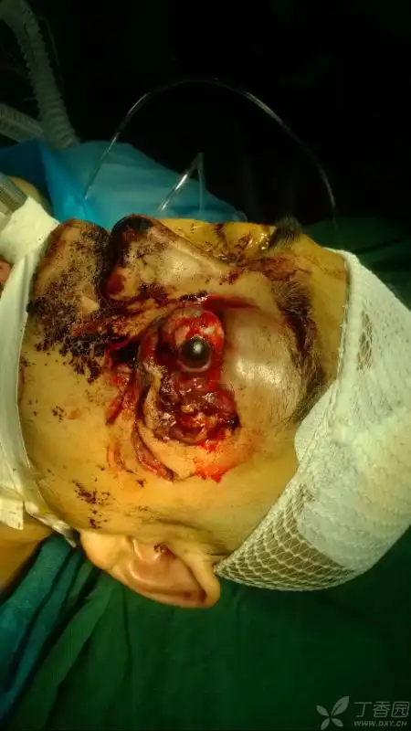 眼科 眼眶病/眼整形 帖子详情psb.