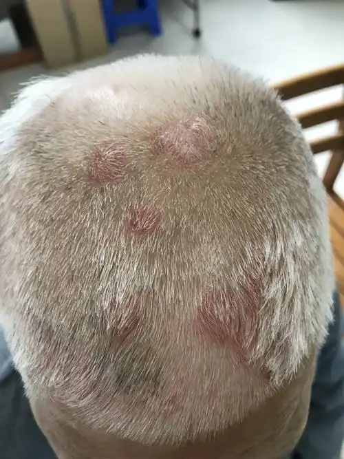 头皮真菌病一例治疗前后对比 - 好大夫在线