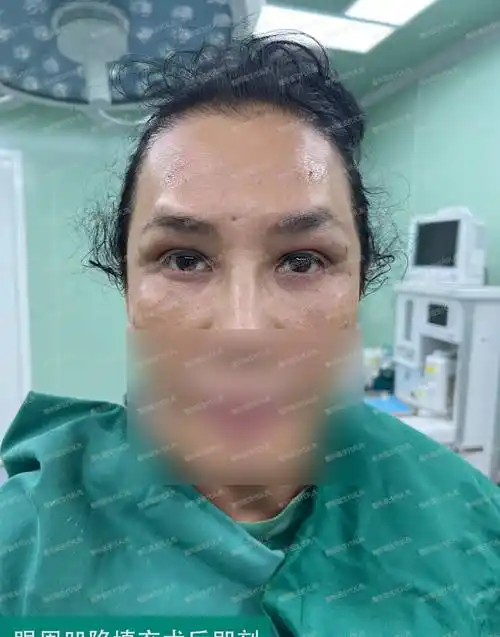 54岁女士做了眼窝凹陷填充术前术后对比,眼睛有这几个变化_脂肪_皮肤