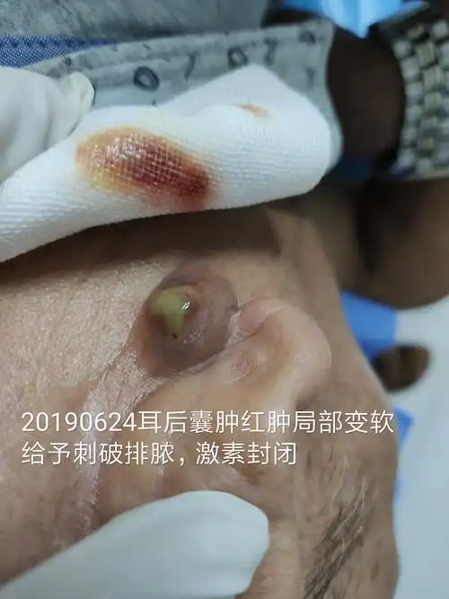 耳后化脓性囊肿 - 好大夫在线