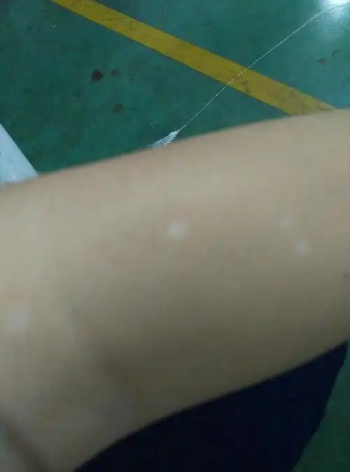 有没有人有过汗斑