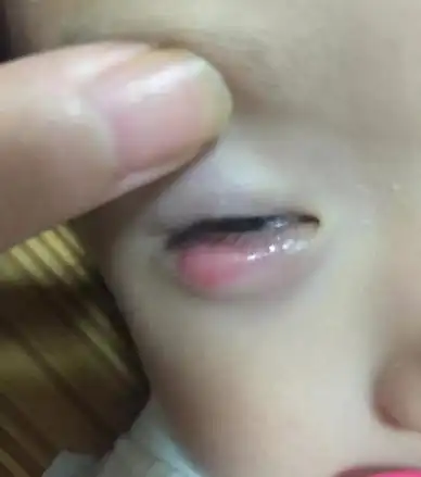 宝宝眼睛长了个小囊肿医生就建议手术还全麻 这合理吗