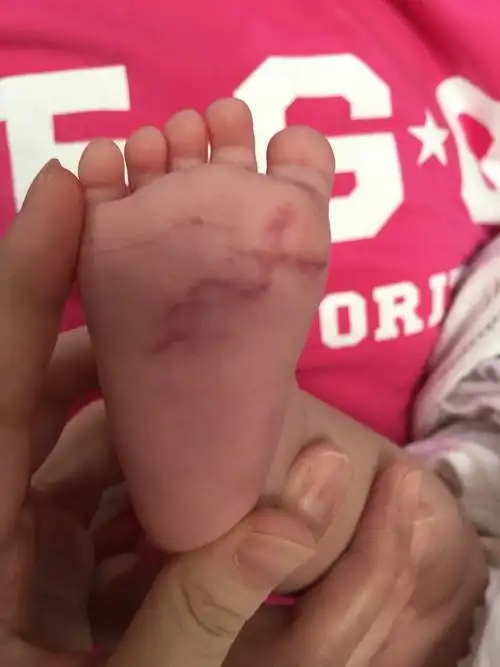 宝宝脚底有淤血怎麼回事