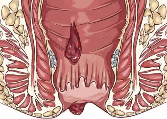 痔疮长什么样?痔疮会自己缩回去吗?哪些手术可治痔疮?