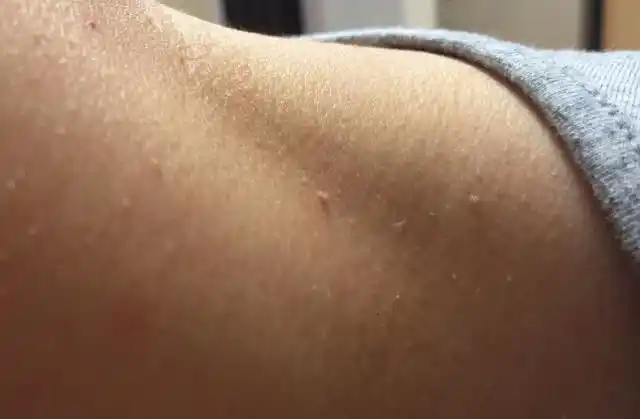 颈部皮肤上长了"小肉粒",是什么东西?该怎么办呢?