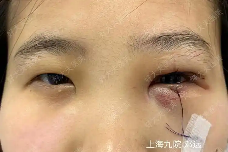 次左眼上睑下垂术后复发,于我院行二次矫正术,采用额肌悬吊的方式手术