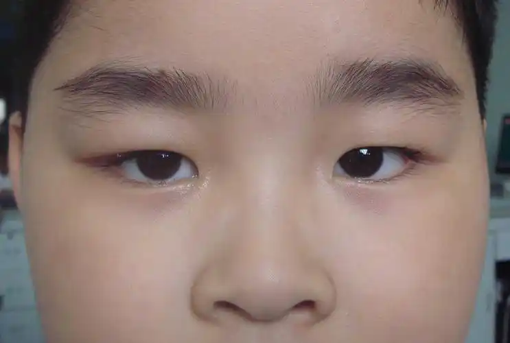 病例3:患者男,14岁,左眼先天性上睑下垂.麻醉方式:局部浸润麻醉.