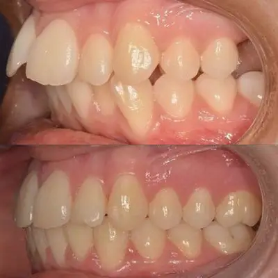 牙齿矫正前后对比效果