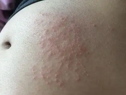 女性湿疹症状图片 (3)_有来医生