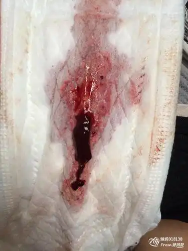 (有图慎入)破腹产月经有血块,什麽问题,有图_第3页_帮