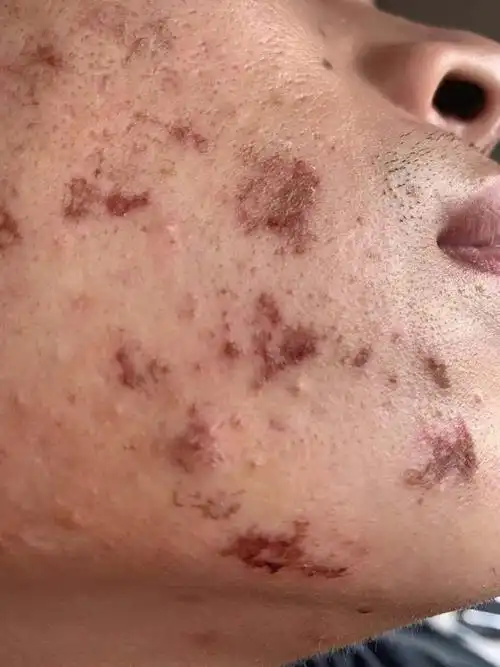 果酸刷脸上没有一分钟疼的受不了 让洗掉了,护士医生都说不会结痂