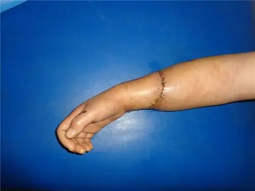 (术后10天)断肢再植,要把离断的骨骼,肌腱,神经,血管全部重建连接,对