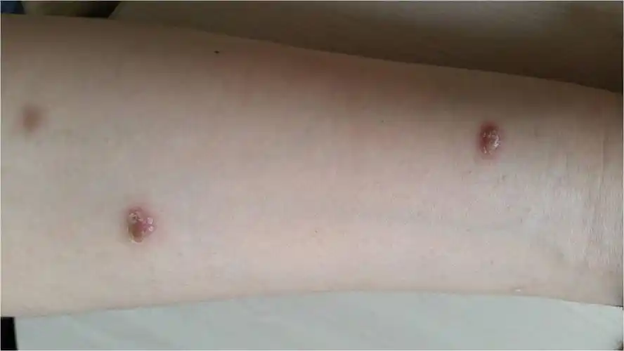 梅毒疹女性硬下疳(一期梅毒)男性硬下疳(一期梅毒)它是一个螺旋状的微