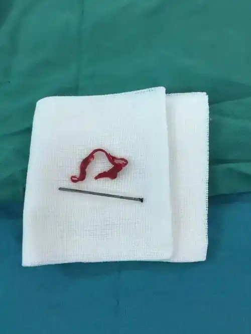 男童玩气钉枪朝自己开枪 5厘米钉子射中小心脏