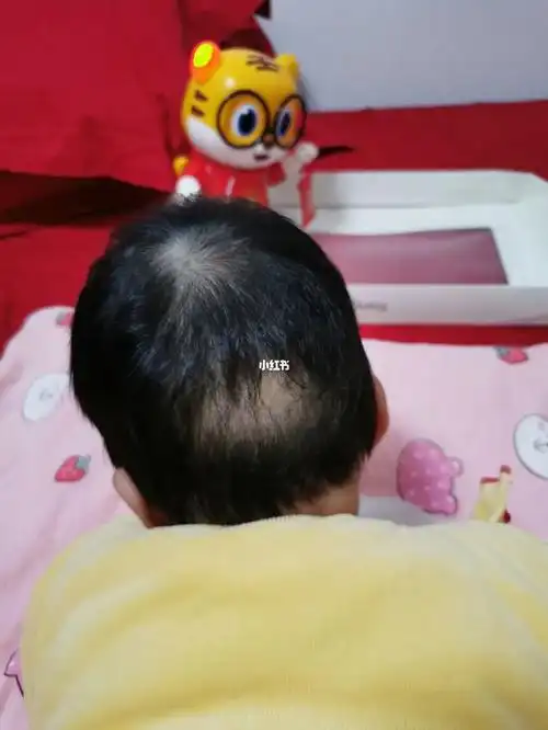 哪个小宝宝的后脑勺缺了一块头发呀哈哈哈