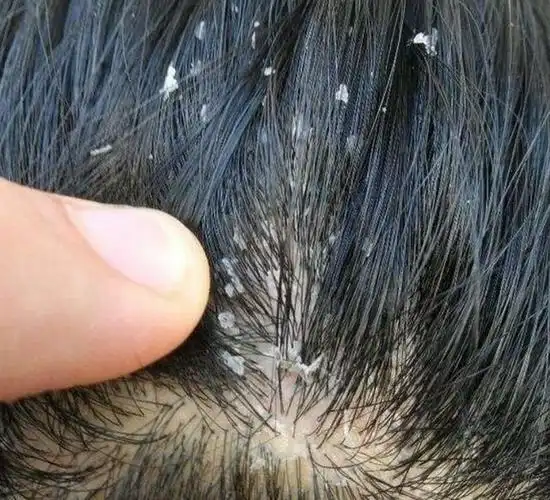 每次梳洗头发,总是一把把掉,你可要长点心,这是螨虫头上做窝了