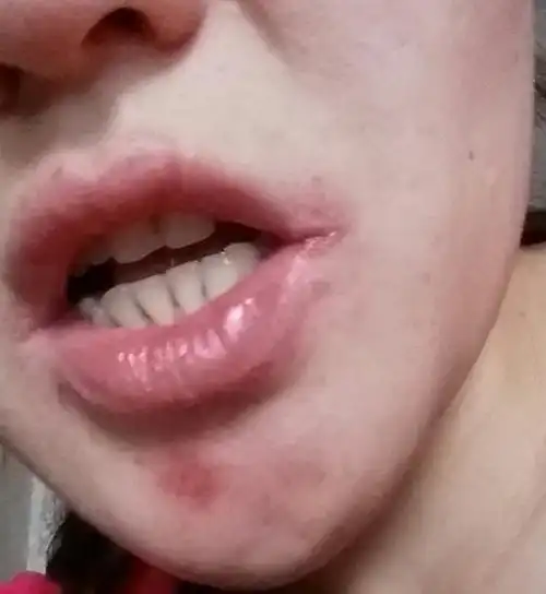 嘴角边烂了,怎漠办,是什么原因