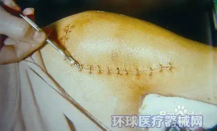 制造 "cak常安康"牌医用吻合器,包皮环切器,切口固定器等微创手术器械