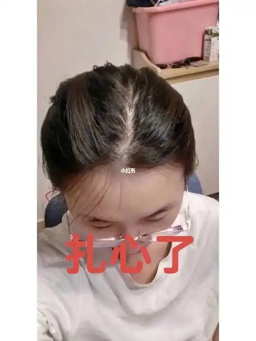 扎心了30岁脱发01