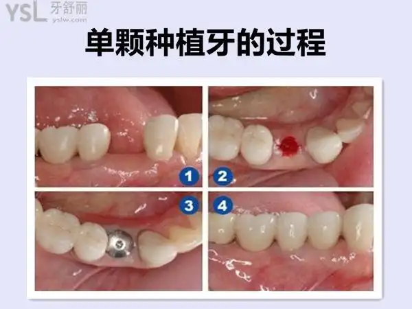 网友138***8294提问:想知道北京种植牙多少钱一颗2021价格表会越来越