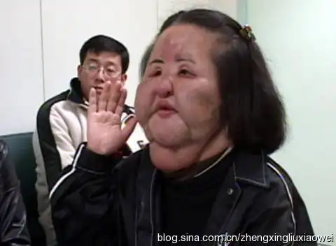 整容遭遇脑死亡图片来源于网络一直以来,赴韩整形失败的案例在网上疯