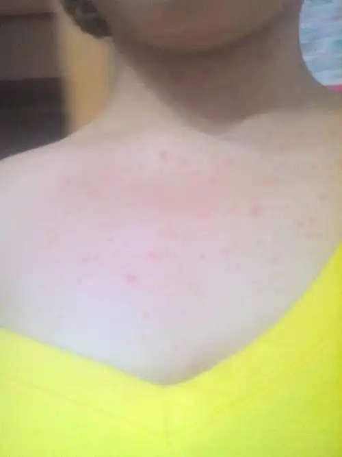 2014-06-18 刘英新 主治医师 吃芒果过敏,前胸脖子脸长红疙瘩后2周才