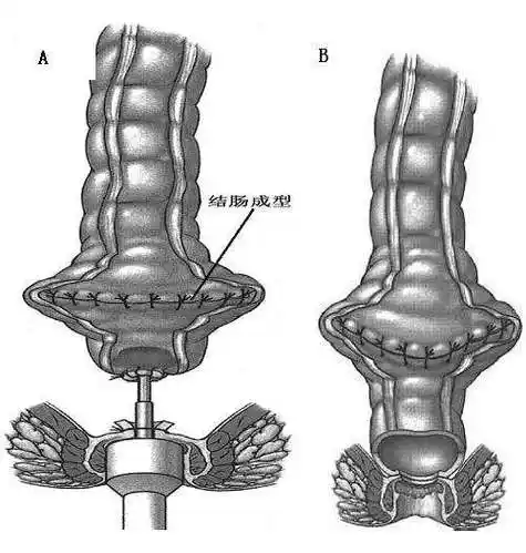 保留 结肠肛管吻合手术使得低位或超低位直肠癌患者得以保留肛门;a