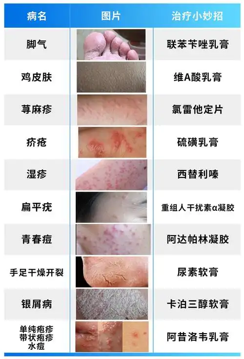 这10种皮肤病一生中难免碰到,教您10个小妙招,希望可以帮到您1,脚气