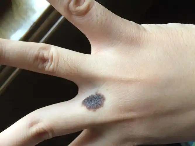 我右手中指无名指的指缝根部有一颗先天痣小时候挺小的我长