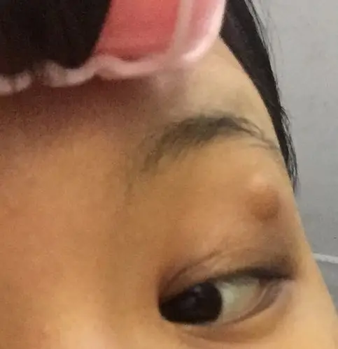 眼皮上方长了一个疙瘩 不痛不痒 两个礼拜左右了 4-5mm 请问这个要去