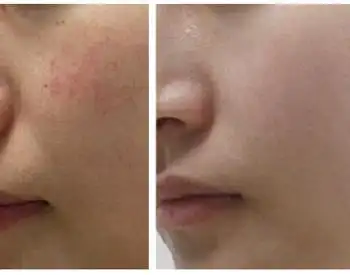 沈阳友谊整形美容医院欧洲之星fotona4d治疗红血丝效果如何?